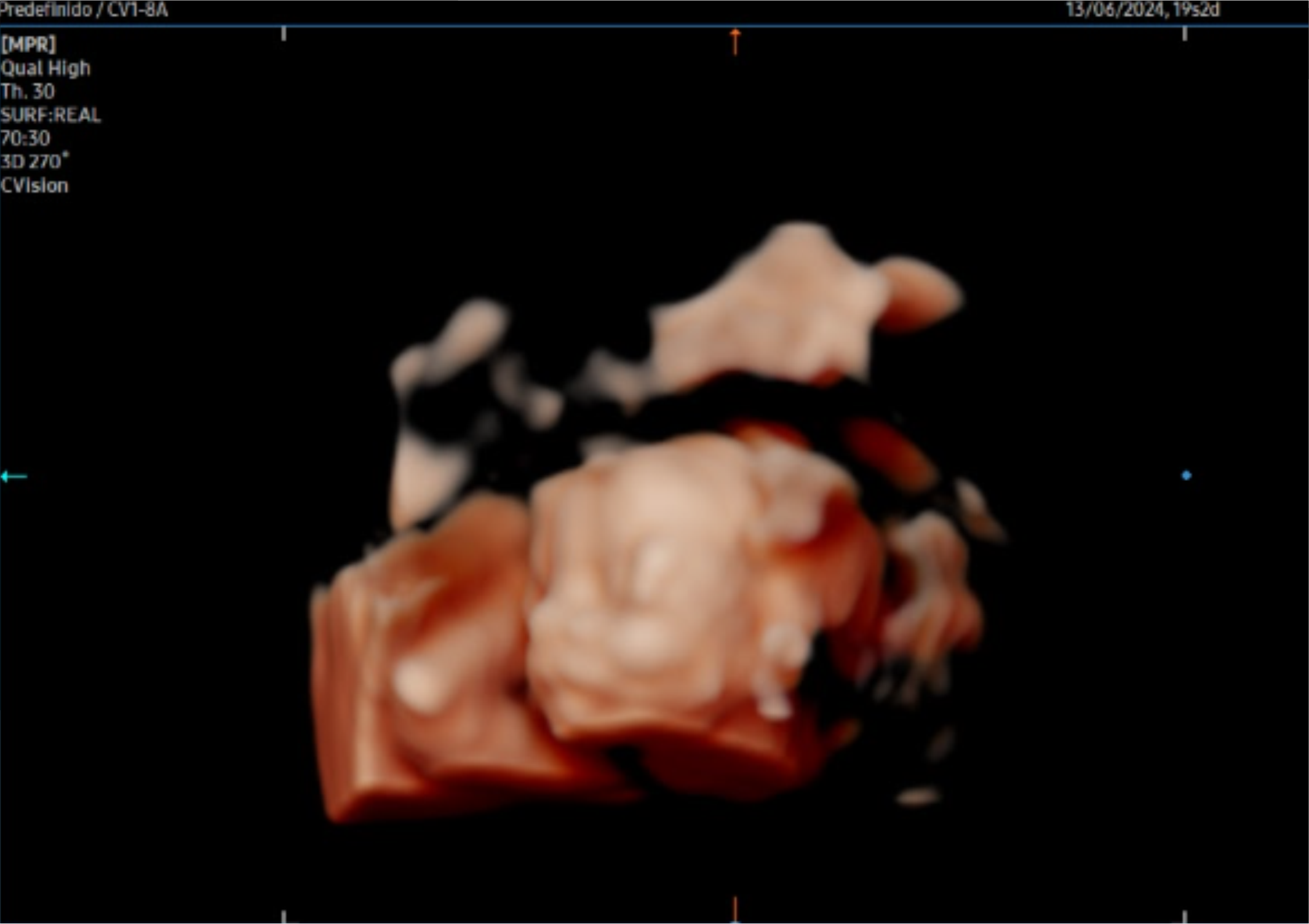 ecografía Doppler