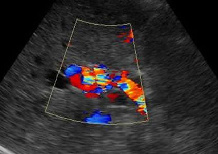 Ecografía Doppler de Hígado - Hipertensión portal